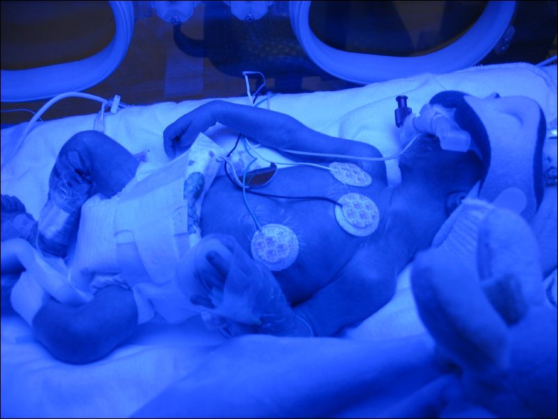 Owen with CPAP & Blue Lights